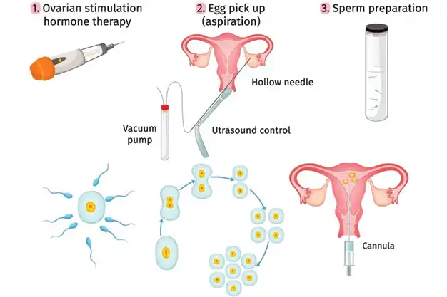 Vitro Fertilization