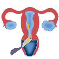 Transvaginal Ultrasound